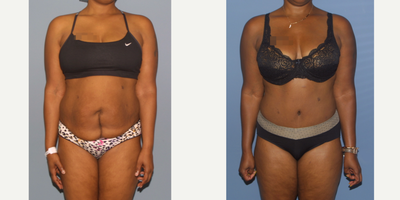 35-44 year old woman treated with Tummy Tuck - Full tummy tuck with muscle repair, note how vertical c-section scar has been traded for a transverse tummy tuck scar that is hidden.