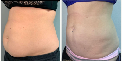 Woman treated with Evolve - Evolve - 3 Months post op - 2 Evolve Treatments