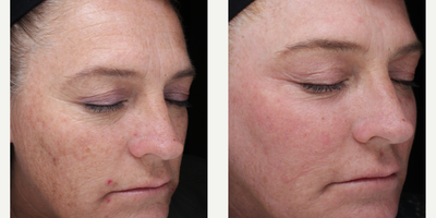 Woman treated with Renuvion - Woman treated with Renuvion
