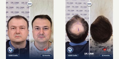 35-44 year old man treated with DHI Hair Transplant, Hair Transplant - 4200 grafts 12 months result DHI Hair transplant