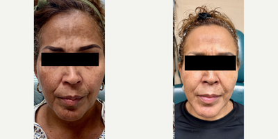 55-64 year old woman treated with Pico Genesis - 55-64 year old woman treated with Pico Genesis