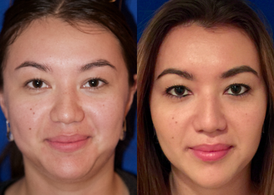 25-34 year old woman treated with Buccal Fat Removal - Buccal Fat Removal