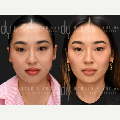 25-34 year old woman treated with Botox, Dysport, Botox for TMJ, Skin Tightening - Botox for masseter reduction