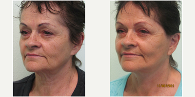 65-74 year old woman treated with Lower Facelift and Necklift Revision - This lovely woman presented to our Center with the complaint of continued sagging neck and lower facial skin after she had a lower facelift and necklift over a year ago by another surgeon.  She felt that she did not receive the tighter neck and jawline that she had expected.  We discussed together the plan of a revision lower facelift and necklift to restore the contour that she wished for.  The procedure was performed under local anesthesia in our office setting in just under two hours.  Only light oral sedation with valium was given along with the local anesthetic (lidocaine).  Her recovery time was about 10 days and was back to most activity at that point in time.  Her after photos demonstrate a much better contoured neckline and jawline while keeping a natural appearance.
