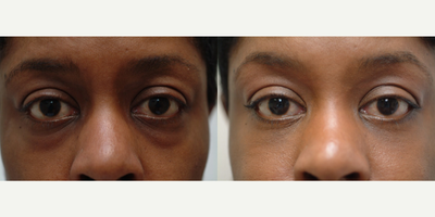 44 year old woman treated with Eyelid Surgery - Lower Eyelids / Bag Treatment