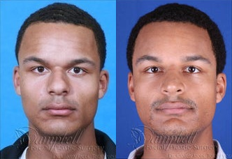 Rhinoplasty - 	Patient underwent rhinoplasty