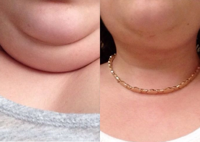 Post op - this patient had a little double chin and an extensive lipo in that area