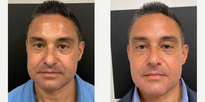 Man treated with Rhinoplasty - Man treated with Rhinoplasty