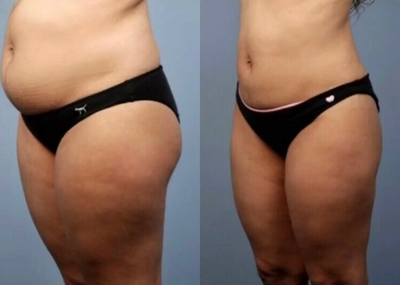 Woman treated with BodyFX - Woman treated with BodyFX