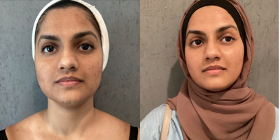 35-44 year old woman treated with AviClear - Patient came in with moderate to severe acne. She has been struggling for years. After a series of AviClear and customized acne facials we achieved this result. She will continue with her Skinbarre reccomended skincare routine and acne facials.