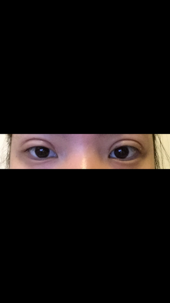 double eyelid surgery toronto