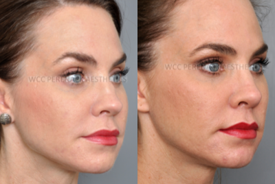 35-44 year old woman treated with Revision Rhinoplasty - This patient received a Rhinoplasty by another surgeon years prior to coming to us for a Revision Rhinoplasty.