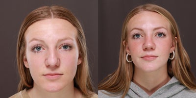 17 or under year old woman treated with Nonsurgical Nose Job - Surgical Rhinoplasty with Dr. Thompson. Age 17, 7 months postoperative. The swelling will continue to decrease every month over the course of a year.