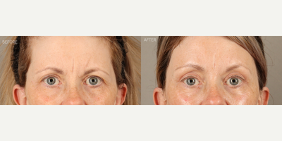 Temporal Brow Lift, Upper Blepharoplasty and Full-Face Fractionated CO2 Laser - 58-year-old female who was concerned about her eyes looking tired. She is shown 6 months after a temporal (lateral) endoscopic-style brow lift, upper blepharoplasty and full-face fractionated CO2 laser. The combination of surgeries created a more youthful upper eye contour, relieved tension on her forehead and refreshed her skin.