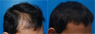 Man treated with Hair Loss Treatment - 1840 grafts