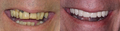 Before and After Permanent Teeth-in-1-Day - Male
Same-Day&nbsp;