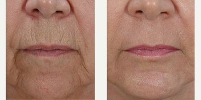 Woman treated with Skin Tightening - Woman treated with Skin Tightening, 6 years post op.