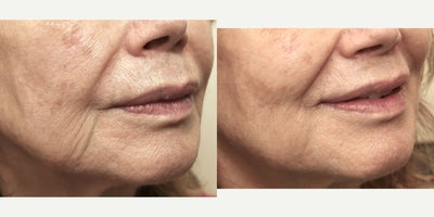 74 year old woman treated with RHA Collection Fillers - 74 year old female complaining about the creases visible lateral to her lips. These lines were improved with the use of 1 syringe of RHA Redensity hyaluronic acid injectable filler.