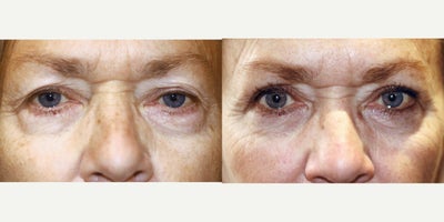 53 year old woman treated with Eyelid Retraction Repair - 53 year old woman treated with Lower Blepharoplasty Surgery for puffy lower eyelids.