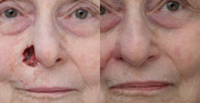 Facial Reconstructive Surgery - Facial Reconstructive Surgery