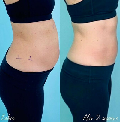 Woman treated with Evolve - Woman treated with Evolve