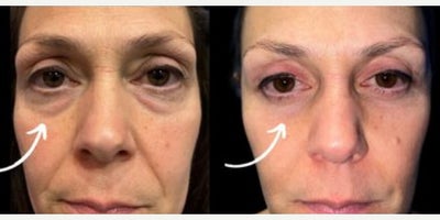 Woman treated with Eyelid Surgery - Woman treated with Eyelid Surgery