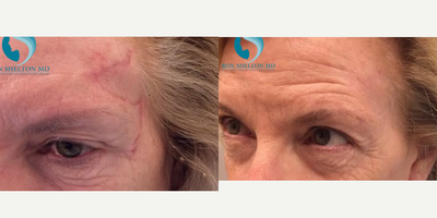 Fraxel Laser Treatment for Scar Removal - After a series of Fraxel Laser Treatments