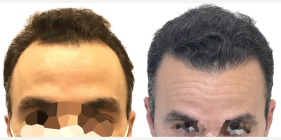 38 year old man treated with Rogaine - This is a 38-year old male with progressive, androgenetic hair loss starting at about age 18. He was on finasteride for about 10 years when it first started but stopped at about age 28 because he just felt that he didnt want to be on oral medication anymore. Unfortunately, though, once he stopped the finasteride, his hair started falling out.More recently hed started daily minoxidil which was working well to prevent any more hair loss, but as expected, it didnt do anything to regrow the deepening recessions on both sides of his hairline. He was seeking restoration with surgery. You can really see those recessions once we shaved his head just prior to getting started. At the same time, he wanted a little more density behind his hairline in the frontal scalp, as well as a few grafts scattered over the crown, just to add a slight bit of density there.He had a 2461 graft FUE, with most of the grafts allotted to filling those recessions on either side of his hairline. We also added a few through the remainder of the frontal scalp and just a small amount in the crown.Hes had a great result! The recessions are restored and his hairline looks really natural! Hes still using his daily minoxidil to prevent ongoing hair loss and this is the kind of restoration that will age with him really naturally for decades to come. Even though we extracted more than 2400 grafts, weve done it in such a way that his donor area still looks really full. Youd really never be able to tell that this patient had a hair transplant!