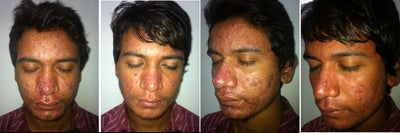 Acne after one month treatment with Accutane - Patient got quite obvious improvement after first month treatment with accutane.