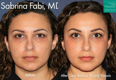Woman treated with Clear and Brilliant - Clear + Brilliant, IPL, and Silhouette Instalift to refresh face by Dr. Fabi