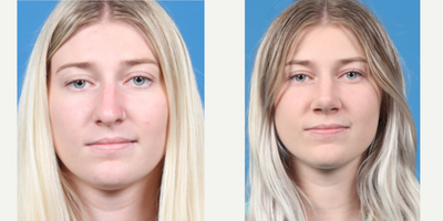 18-24 year old woman treated with Septoplasty - Septo-Rhino plasty