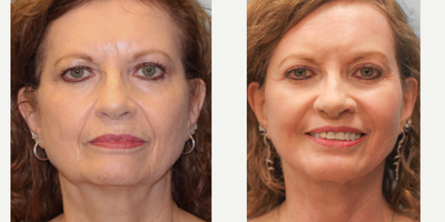 Woman in her late 60s treated with Facial Fat Transfer - Woman in her late 60s treated withFacial Fat Transfer as well asFaceliftand TFXLaser Resurfacing, shown 3 months post op. Pre-op, patient was concerned about the excess skin around her jowls and neck.