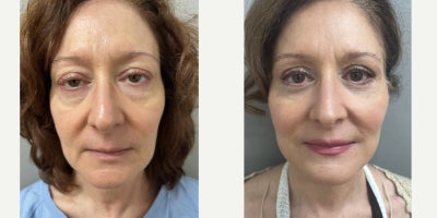 55-64 year old woman treated with Facelift - NaturalLift facelift with upper and lower eyelid surgery (blepharoplasty) under sedation in our office O.R.