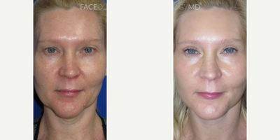 Woman treated with Facelift, Neck Lift, CO2 Laser, Eyelid Surgery - This patient was concerned with laxity in her neck, hyperpigmentation, and heavy upper eyelids.She came to Dr. Lee for our signature Faceology LIFT, along with CO2 Laser Resurfacing, and an Upper BlepharoplastyHer after photos are one month post-op.