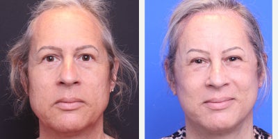 55-64 year old transgender woman treated with Facial Feminization Surgery - facelift, browlift, brow bone reduction, hairline advancement, AFG: cheeks, lips, HALO full face.