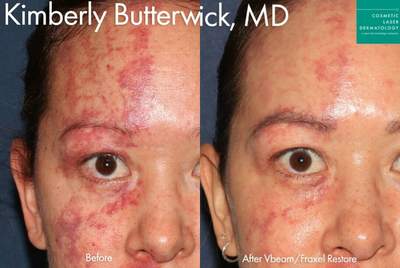 Woman treated with Vbeam - Vbeam and Fraxel Restore to treat port wine stain by Dr. Butterwick