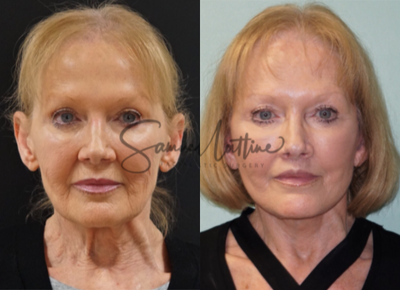 65-74 year old woman treated with Facelift Revision - Revision Lower face/neck lift and upper lip lift