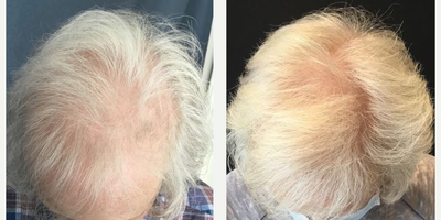 65-74 year old woman treated with PRP for Hair Loss - Patient was treated with PRP for Hair Loss