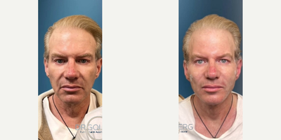 Man treated with Nonsurgical Facelift, Nonsurgical Neck Lift - Man treated with Nonsurgical Facelift, Nonsurgical Neck Lift