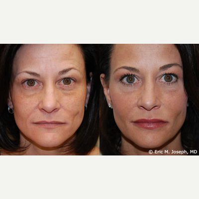 Facial Rejuvenation with Silikon 1000 - Microdroplet Silikon-1000 has a history of precision, permanence, and versatility. Treating several facial areas may lead to a youthful appearance as in our beautiful patient pictured here. She received treatments to her under eyes, cheeks, nasolabial folds, lips, and to a left buccal indentation. Botox was used for rejuvenation of her forehead, brows, eyes, and crows feet.