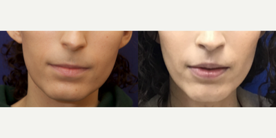 Patient treated with MTF Chin Surgery - Patient treated with MTF Chin Surgery for reduction and contouring