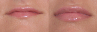 Lip Enhancement - 
	Lip Enhancement, Restylane
