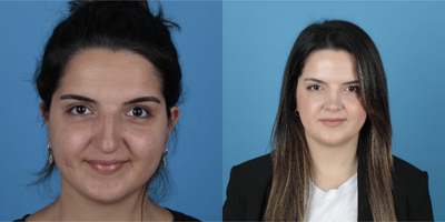 25-34 year old woman treated with Rhinoplasty - Two years post op