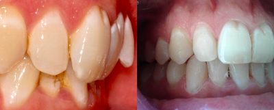 Treated with Six Month Smiles - 3.5 Months Invisalign alignment with acceleration