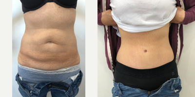 45-54 year old woman treated with Drainless Tummy Tuck - 53 year old patient.