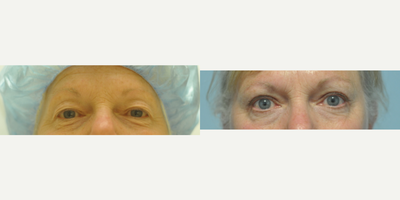 55-64 year old woman treated with Eyelid Surgery - Bilateral upper eyelid blepharoplasty