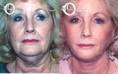 55-64 year old woman treated with Lower Face Lift - Face and neck lift with quick recovery minimal incision