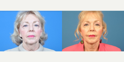 Woman treated with Facelift - Woman treated with Facelift