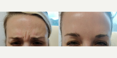 25-34 year old woman treated with Botox - Botox to 11's