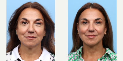 55-64 year old woman treated with Nonsurgical Facelift, Botox - Dr. Wise performed a liquid facelift on this 58-year-old patient using a combination of Botox and dermal fillers. The fillers were strategically injected into the cheeks to contour and subtly lift, diminish under-eye hollows, and add volume. Additionally, Botox was also injected to smooth overall wrinkled skin.
